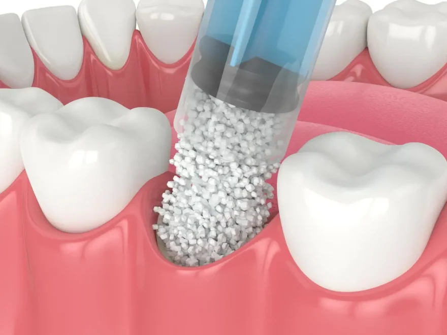 tooth extraction with bone graft