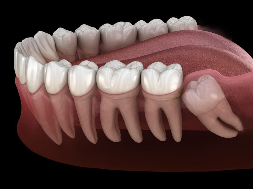 Dental Implants Near Me