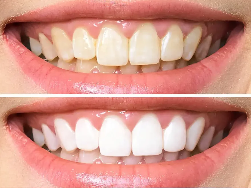 teeth bleaching near me