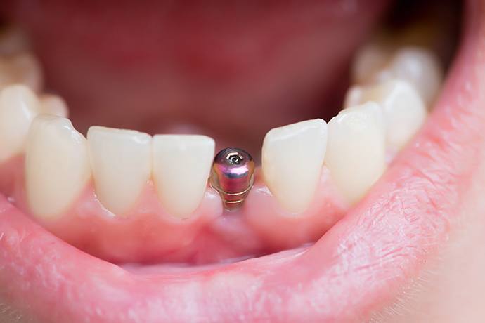 dental implant near me in Houston