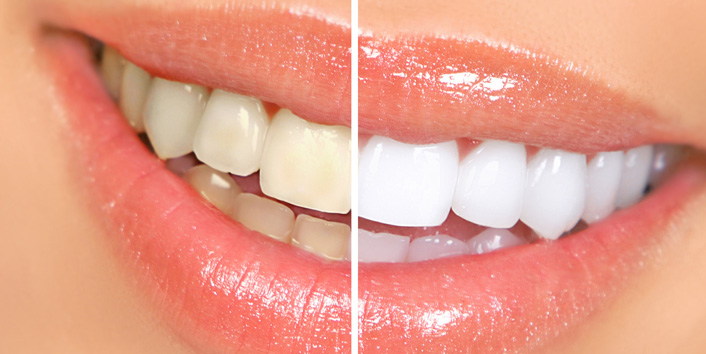 teeth whitening near me in Houston, TX