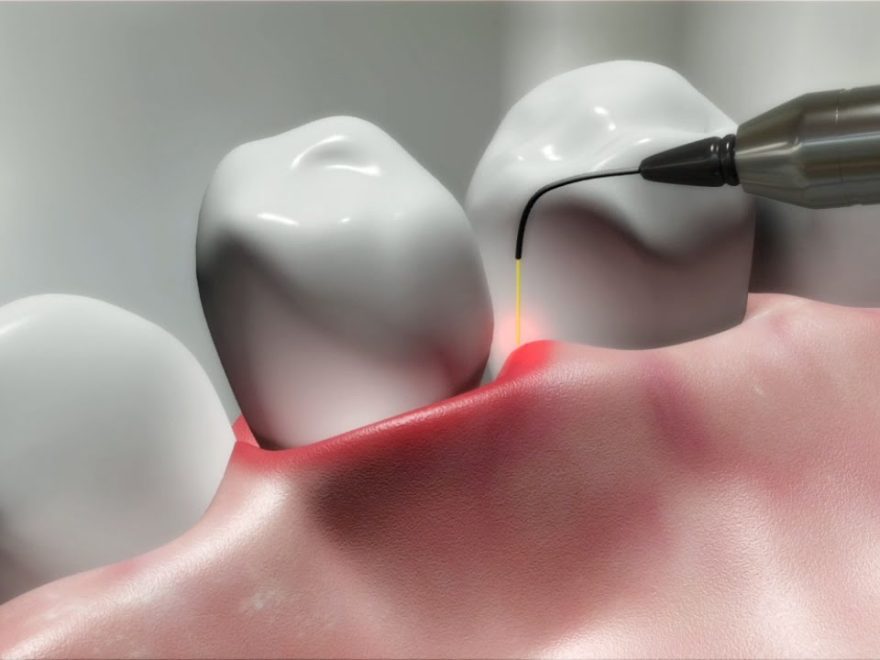 laser gum therapy in Houston, TX