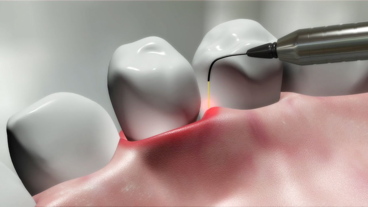 laser gum therapy in Houston, TX