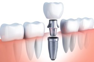 Dental Implants in Aberdeen: A Comprehensive Guide 