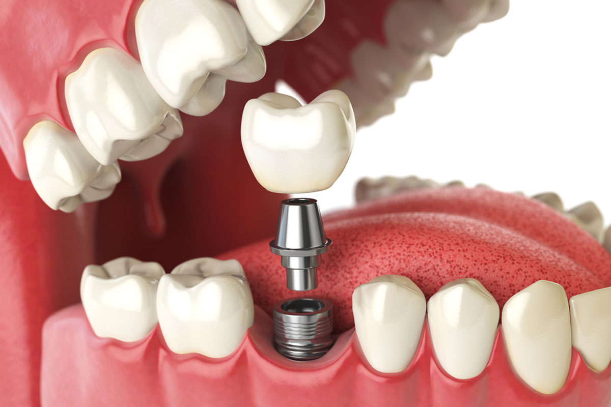 dental implant