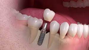 Dental Implants in Aberdeen: A Comprehensive Guide