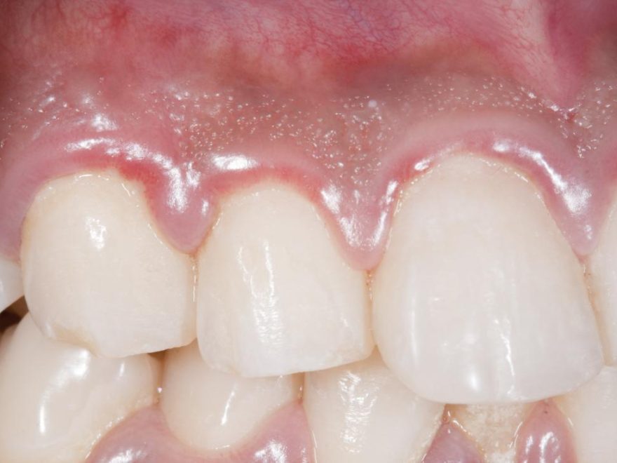 cavities in front teeth