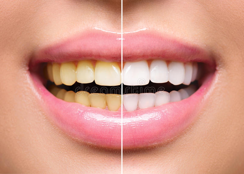 Teeth Whitening Manchester: A Complete Guide