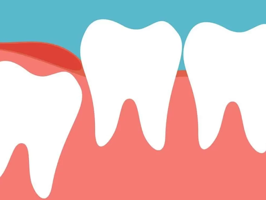 dental abscess treatment in Houston, TX