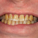 craze lines front teeth