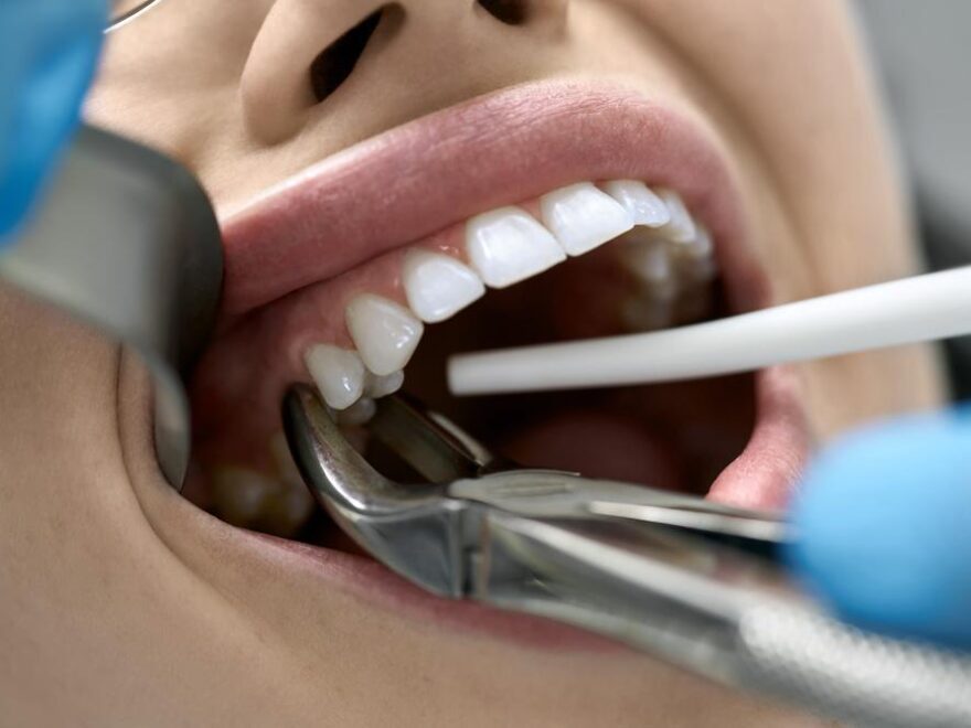 wisdom tooth removal near me in Houston Heights