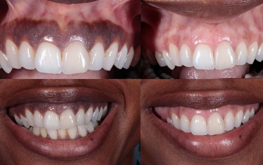 gums hyperpigmentation