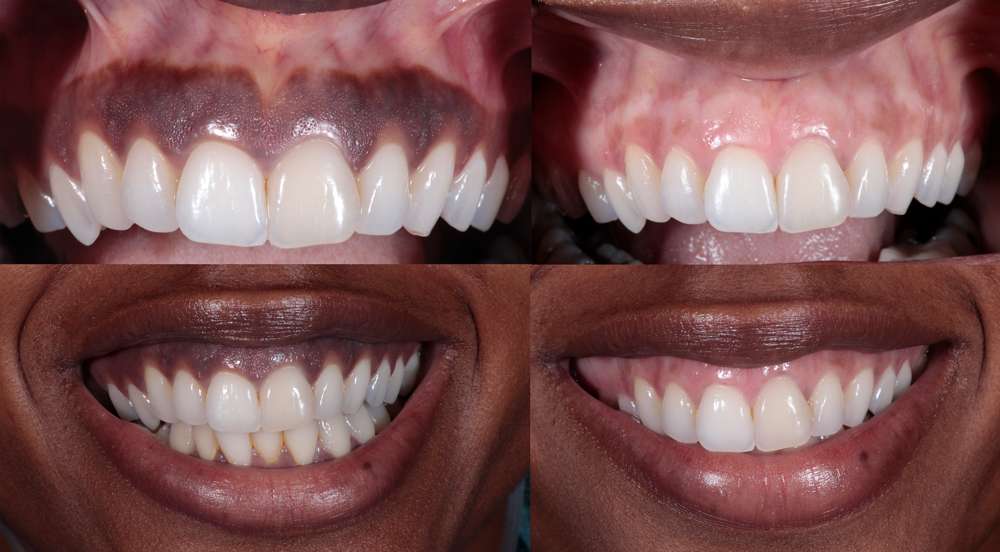 gums hyperpigmentation