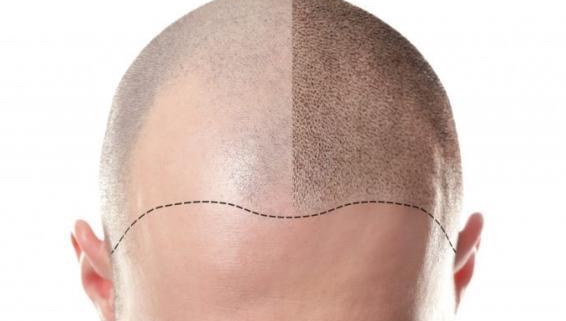 Get Your Hair Back with the Best Hair Transplant Clinic in California