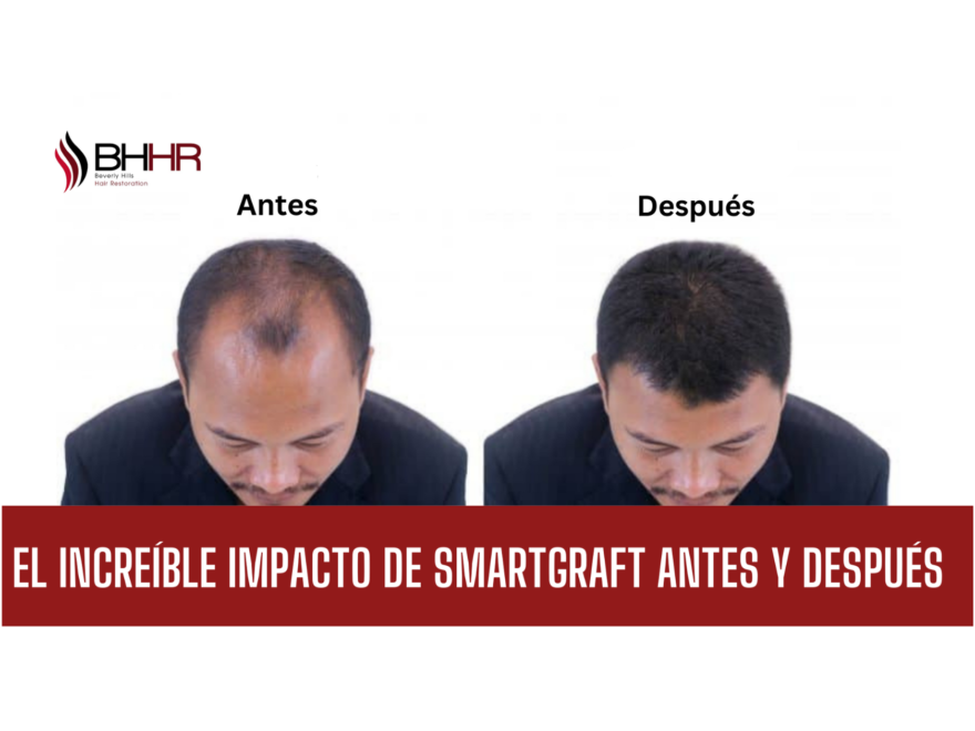 smartgraft antes y despues