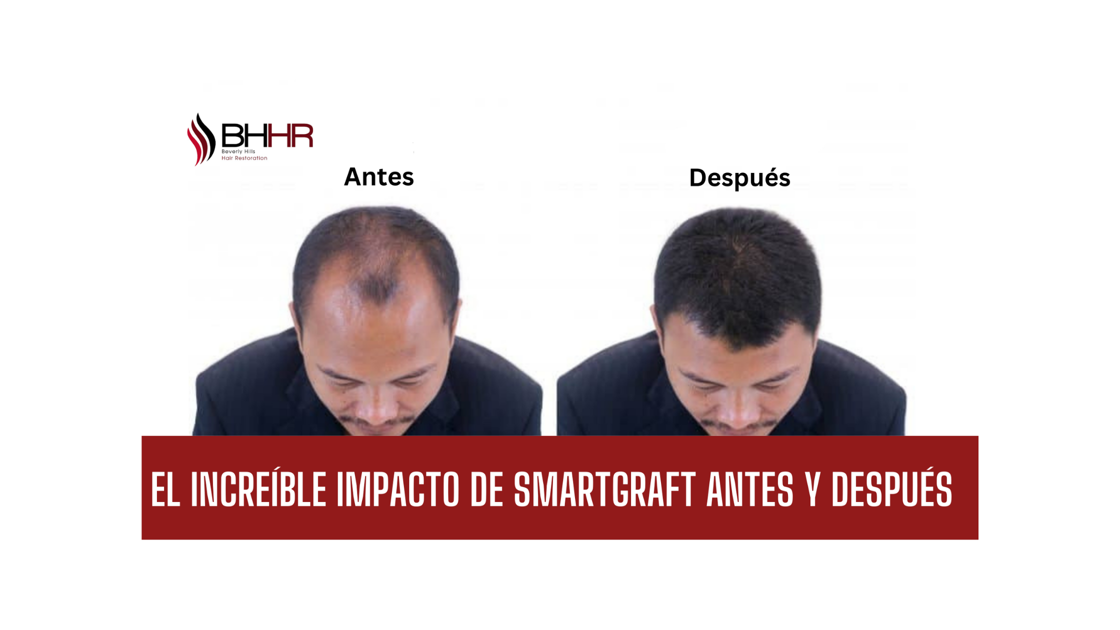 smartgraft antes y despues