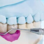 The Complete Guide to Dental Implants in Aberdeen