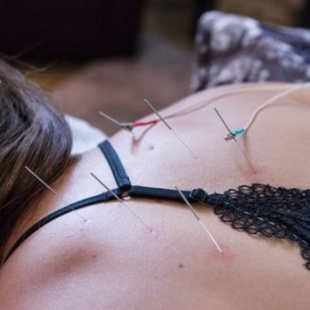 Electroacupuncture in Berkeley