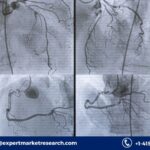 Acute Coronary Syndrome Treatment Market