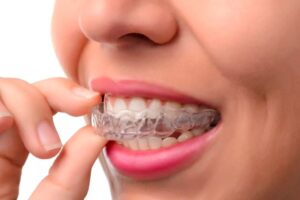 invisalign cardiff