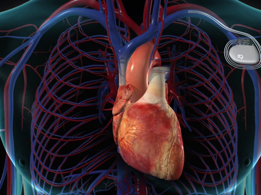 Cardiac Pacemaker Market