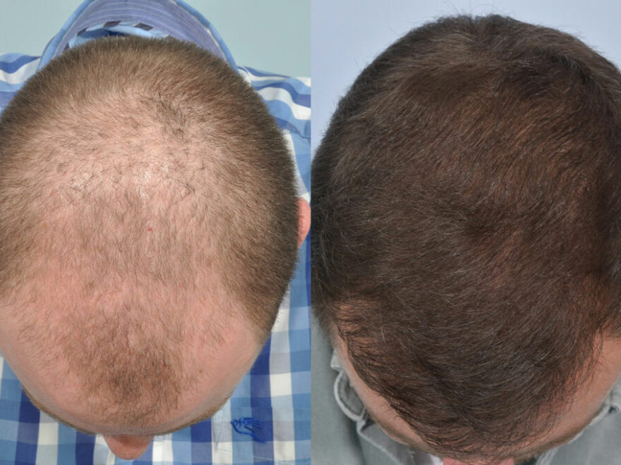 hair transplant in Delhi NCR