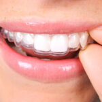 Straighten Your Teeth Discreetly with Invisalign | Invisalign Mississauga