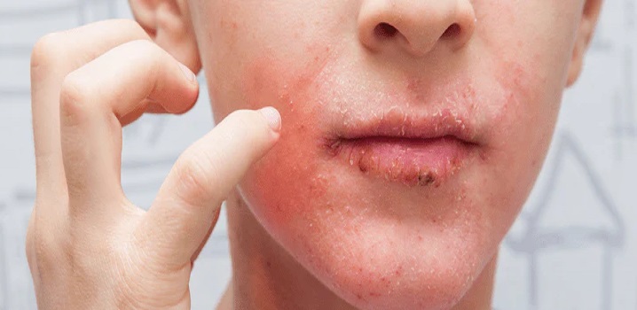 Global Perioral Dermatitis Treatment Market