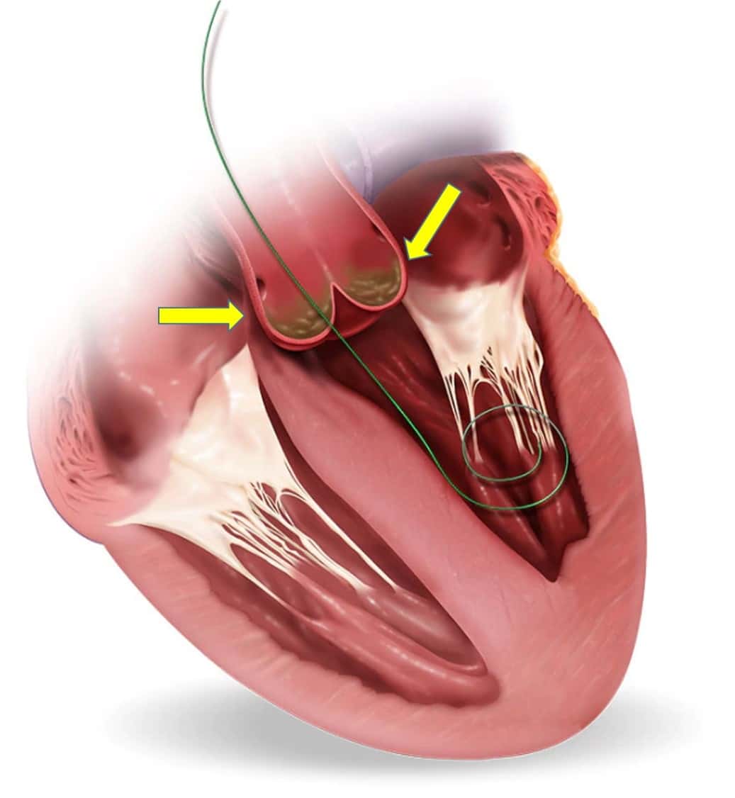 Transcatheter Aortic Valve Implantation (TAVI) Market