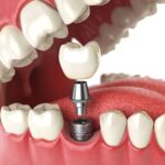 dental implants in Aberdeen