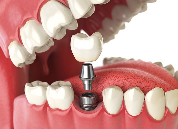 dental implants in Aberdeen