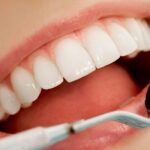 what to expect when it comes to dental crown costs in Houston and provide valuable tips on budgeting for this dental procedure.