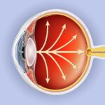 Best Retina Specialist in Dubai