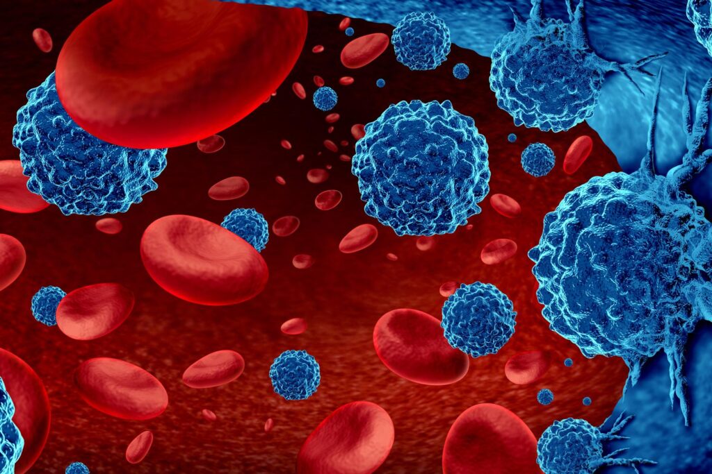 Hematologic Malignancies Market Analysis Report 2023-28