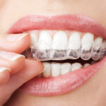 How Can You Maintain Oral Hygiene With Invisialign?