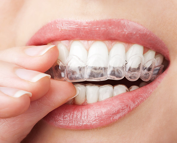 How Can You Maintain Oral Hygiene With Invisialign?