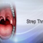 Living with Strep Throat Without Tonsils: A Guide