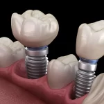 Dental Implants in Aberdeen