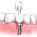 Dental Implants Treatment in Aberdeen