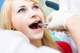 Tooth Extraction Specialist in Dubai