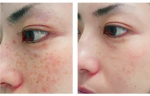 Multifocal Pigmentation