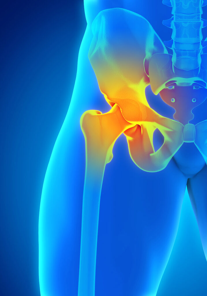 hip bursitis exercises to avoid