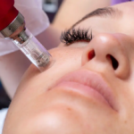 microneedling pasadena