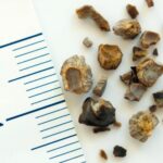 kidney stone removal near me