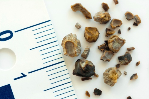 kidney stone removal near me