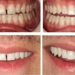 Best Composite Bonding Dentists in Dubai