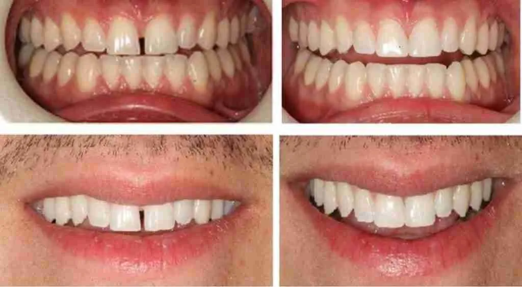 Best Composite Bonding Dentists in Dubai