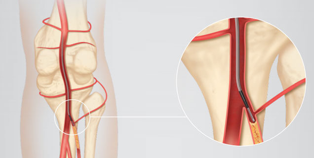 Interventional Cardiology and Peripheral Vascular Devices Market