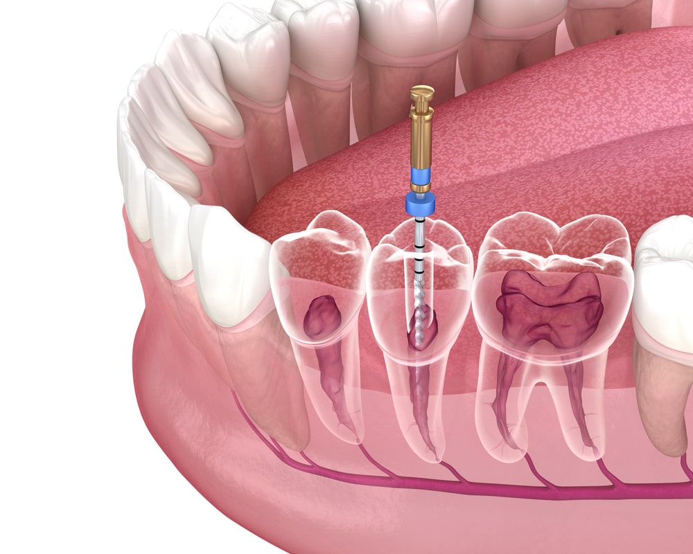 Root Canal Dentist