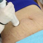 Stretch Marks Treatment Market Size, Share, Growth & Report 2023-2028